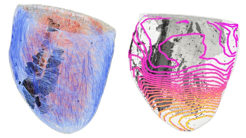 Wie Fibrose elektrische Signale des Herzens stört